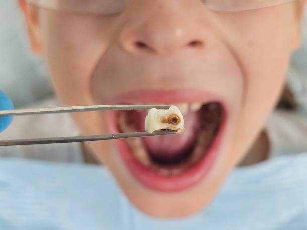 Best Dentist for Tooth Abscess  in Cotter, AR